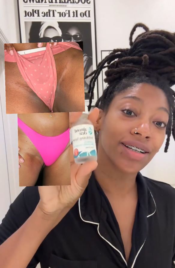 She Wanted a Chemical Peel—Instead, Mandelic Acid Finally Cleared Her Hyperpigmentation